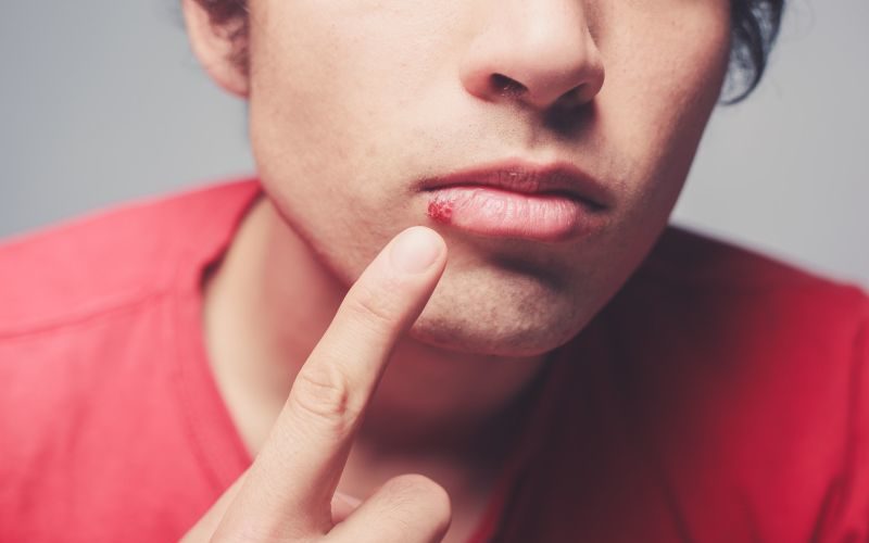 Opryszczka - co na opryszczkę - domowe-sposoby.pl